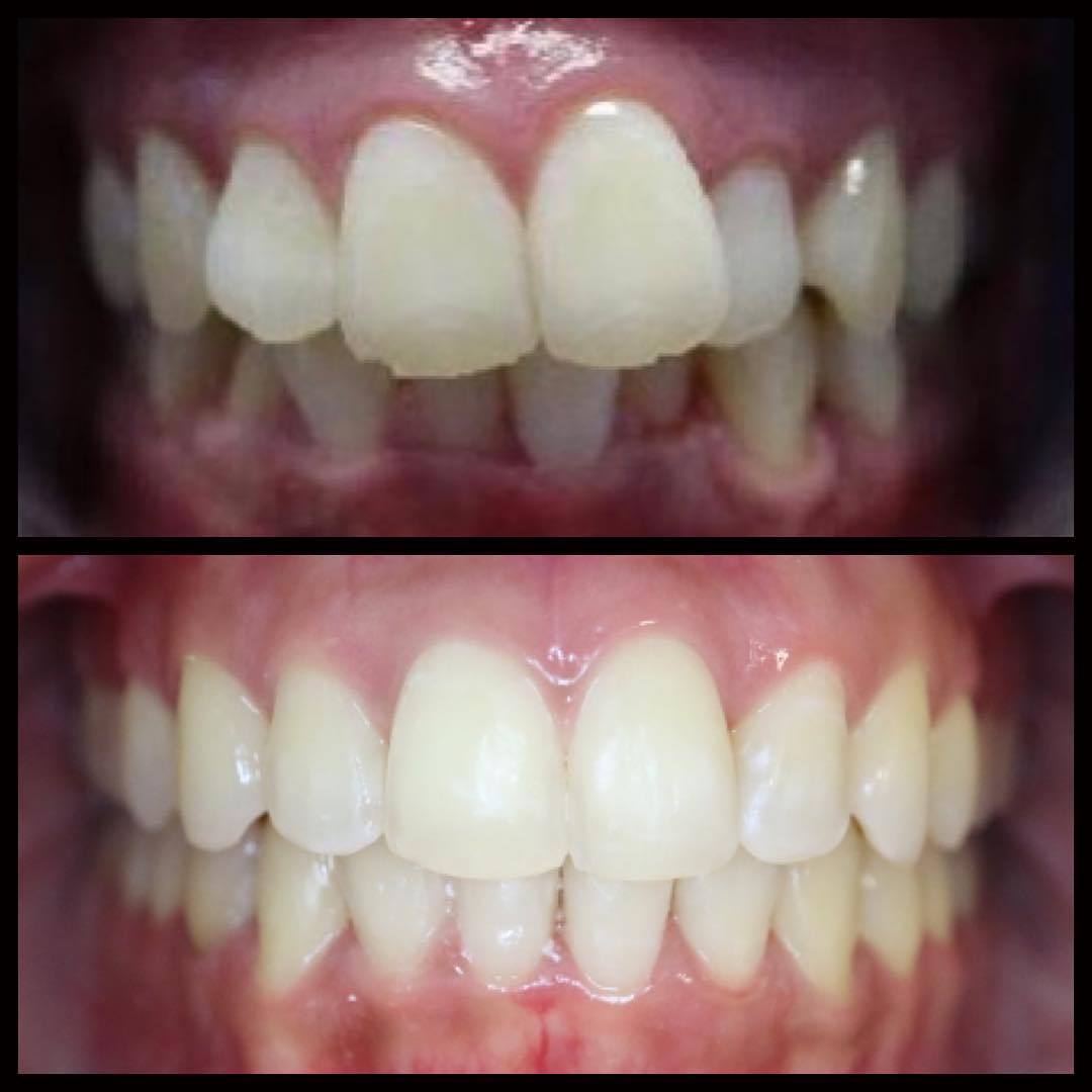Before and after Invisalign alignment, Loukas Dentistry of Park Ridge, IL
