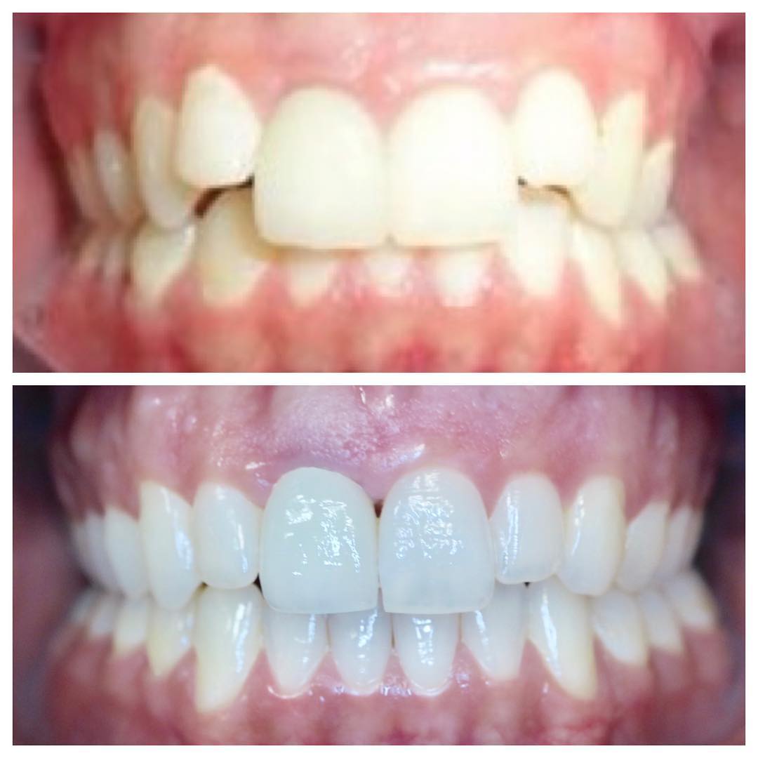 Before and after Invisalign with a brighter, straighter smile, Loukas Dentistry of Park Ridge, IL