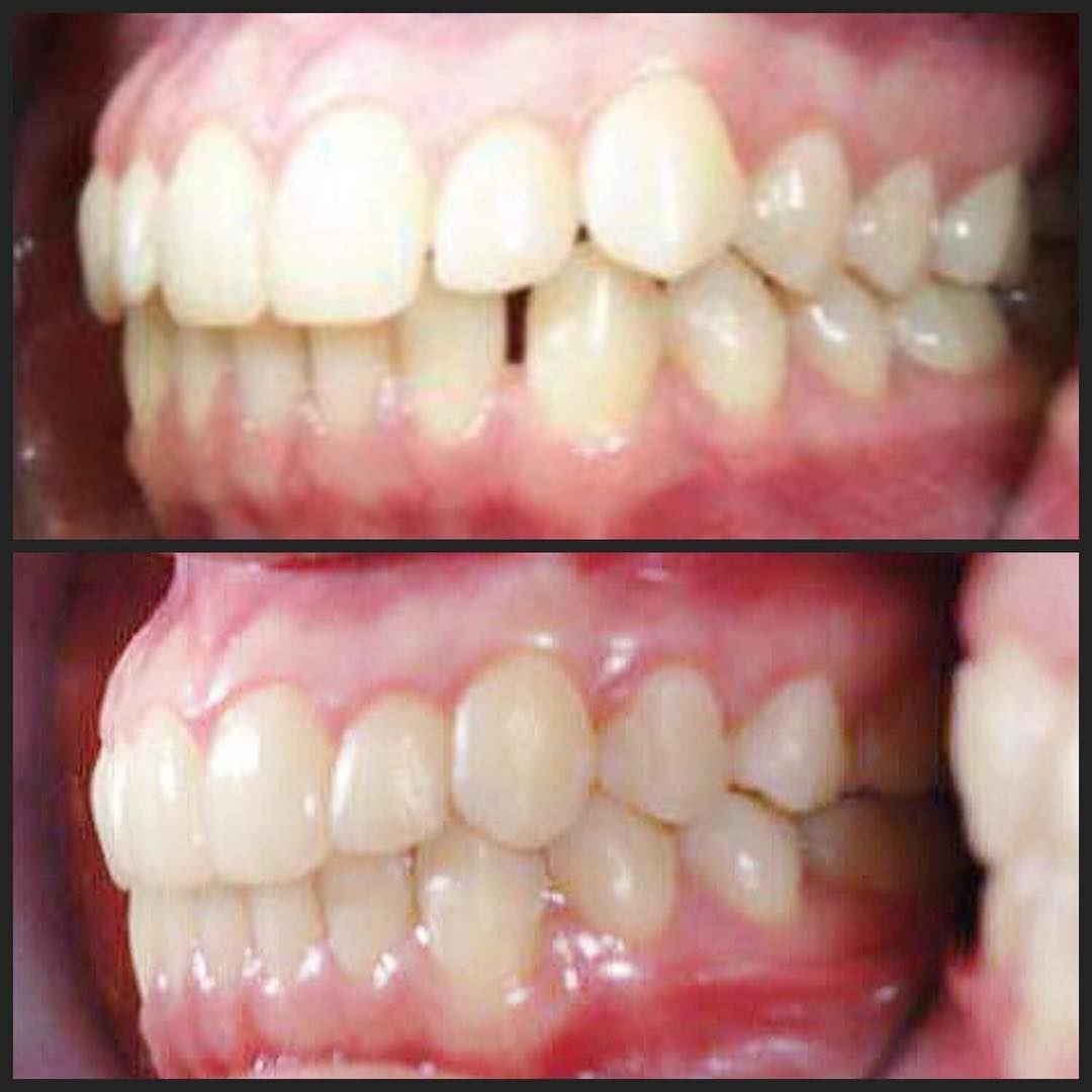 Before and after Invisalign correcting spacing and crowding, Loukas Dentistry of Park Ridge, IL