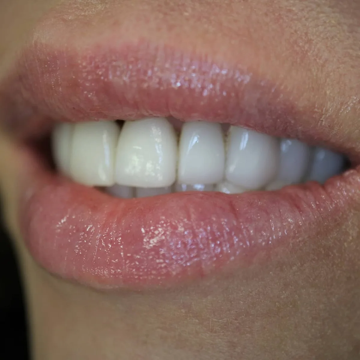 A smile restored with porcelain restorations and lip filler at Loukas Dentistry of Park Ridge, IL