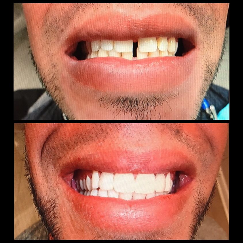 Before and after porcelain veneers closing a gap between the front teeth, Loukas Dentistry of Park Ridge, IL