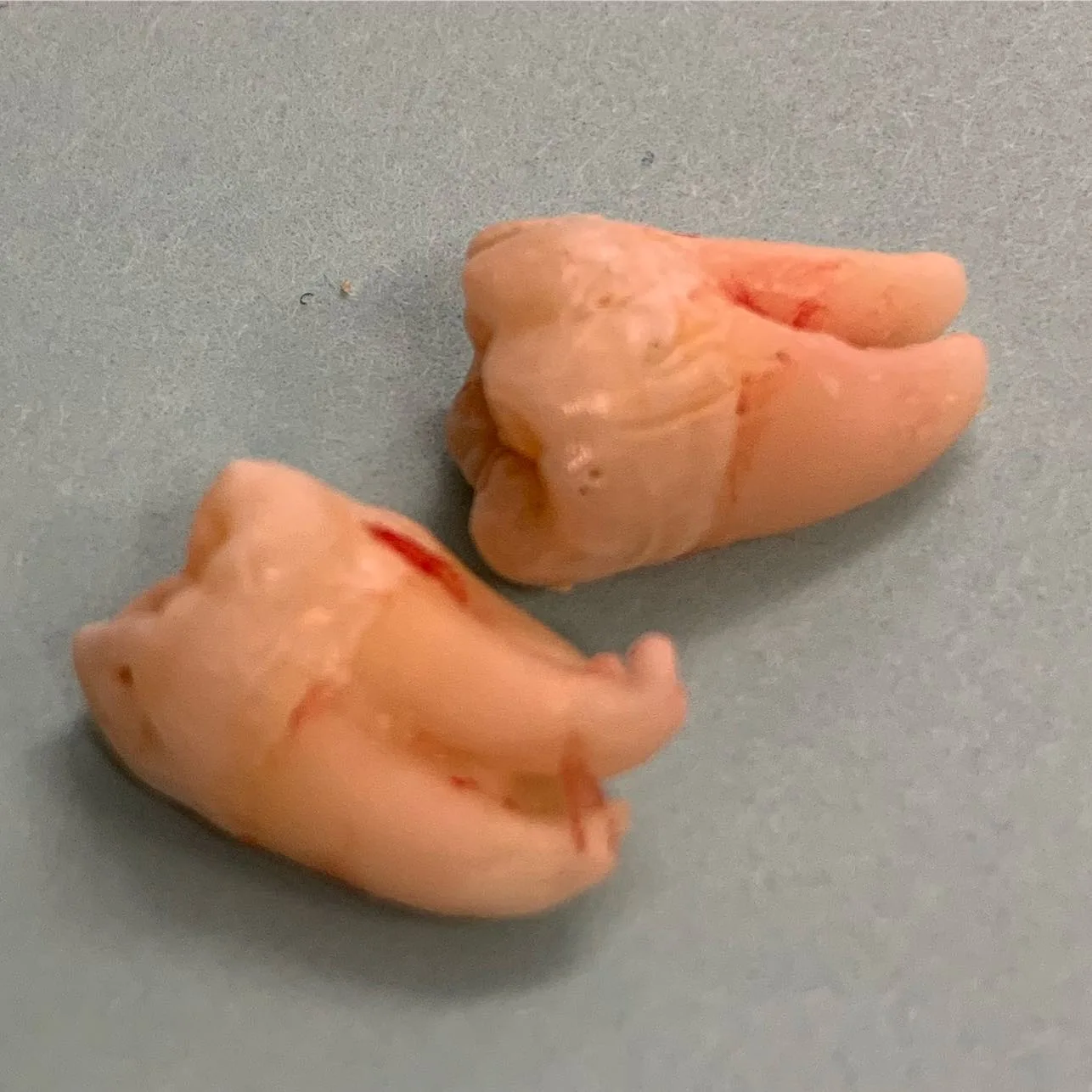 Two teeth removed during a surgical extraction at Loukas Dentistry of Park Ridge, IL, showing the full root anatomy