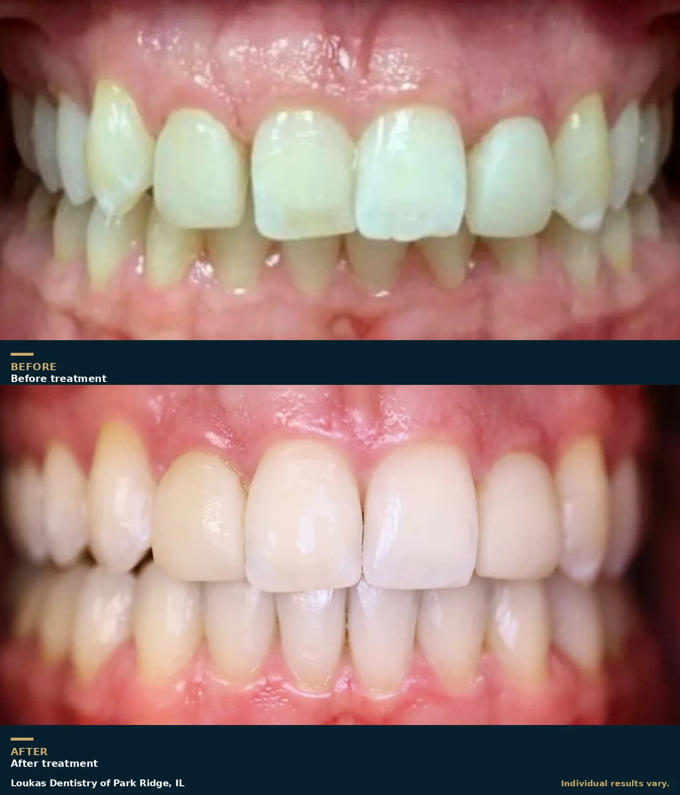 Before and after teeth whitening and restorative dental work at Loukas Dentistry of Park Ridge, IL